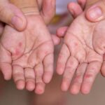El Ayak Hastalığı Belirtileri Nelerdir? El Ayak Hastalığı Nasıl Anlaşılır? Tedavi Yöntemleri Nelerdir?